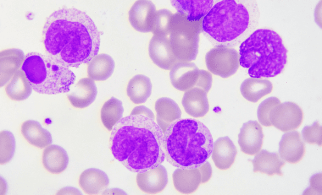 Primeiros Sintomas de Leucemia Identificando os Indícios Precoces