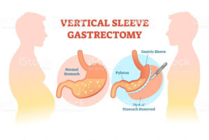 Gastrectomia vertical: o que é e para quem é indicado