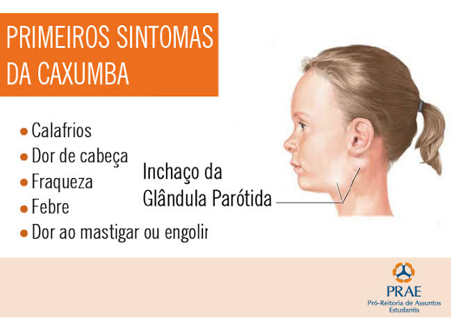 Caxumba é contagiosa? Qual o tratamento?