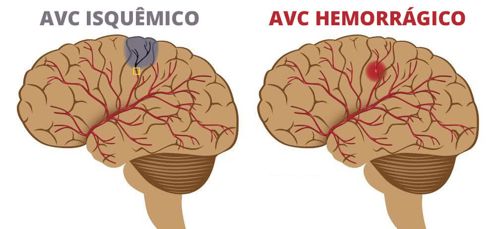 O que é AVC: sintomas e tratamentos