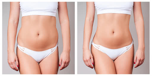 Abdominoplastia: preço e cicatriz 