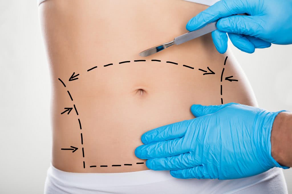 Abdominoplastia: preço e cicatriz 