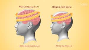 Microcefalia: O que é e como é em bebês