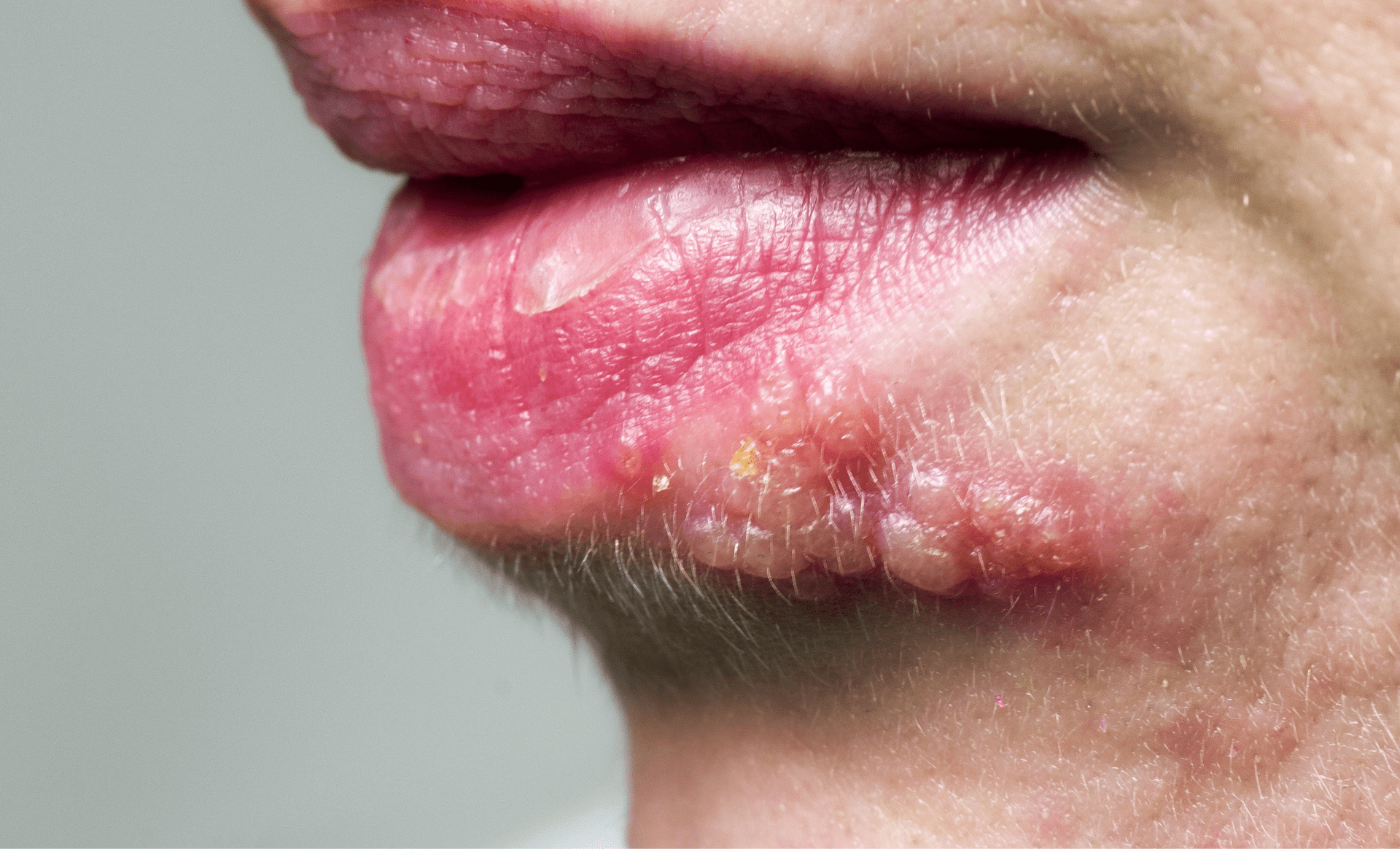 Sintomas de Herpes e Como Lidar com essa doença